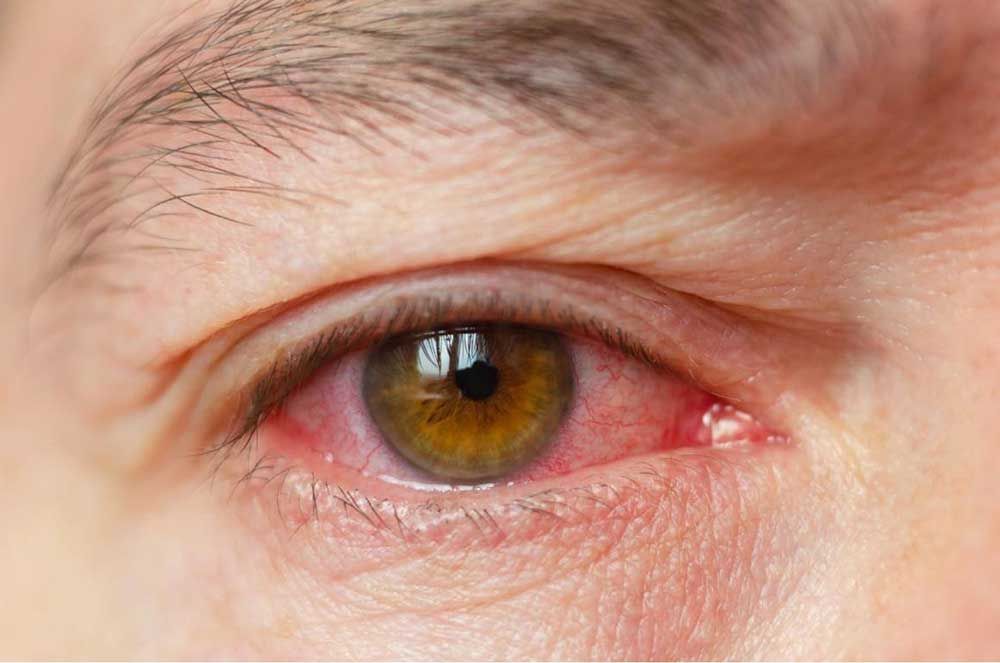 rotes-Auge