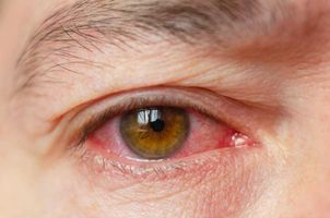 rotes-Auge